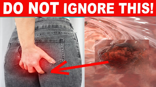 10 Warning Signs of Colon Cancer You Shouldn’t Ignore
