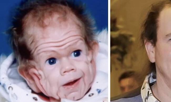 Tomm Tennent: The unique baby born with enough skin to cover the body of a five-year-old child