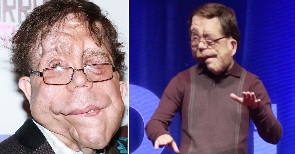 The incredible story of actor Adam Pearson: He’s an inspiration to millions..