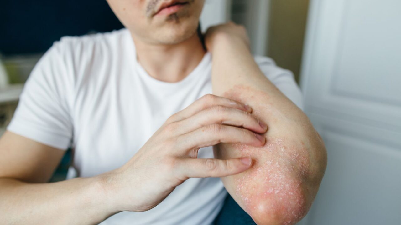 Five Psoriasis Warning Signs You Must Not Ignore
