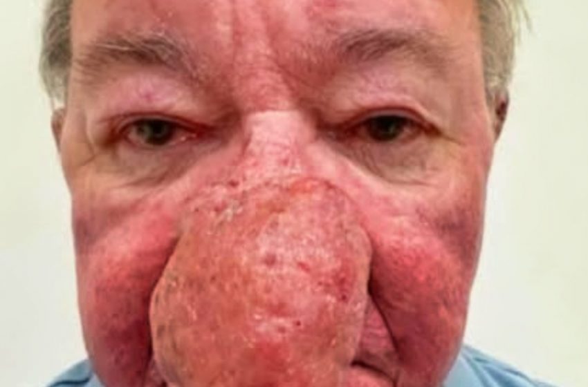 Man with Extreme Nose Growth Stuns Everyone After Surgery!: See The Photos!