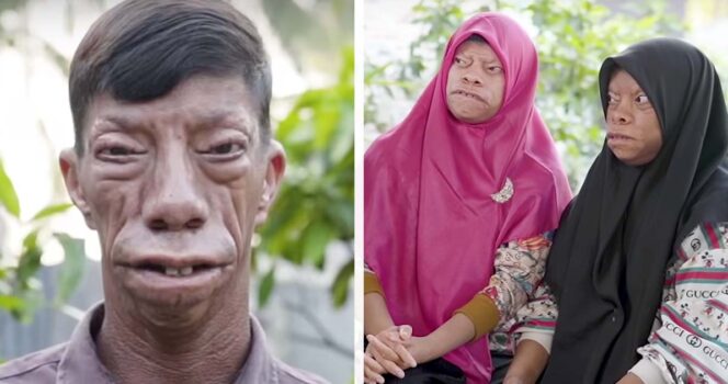 The Manurung family has a mysterious facial condition – now they inspire millions worldwide