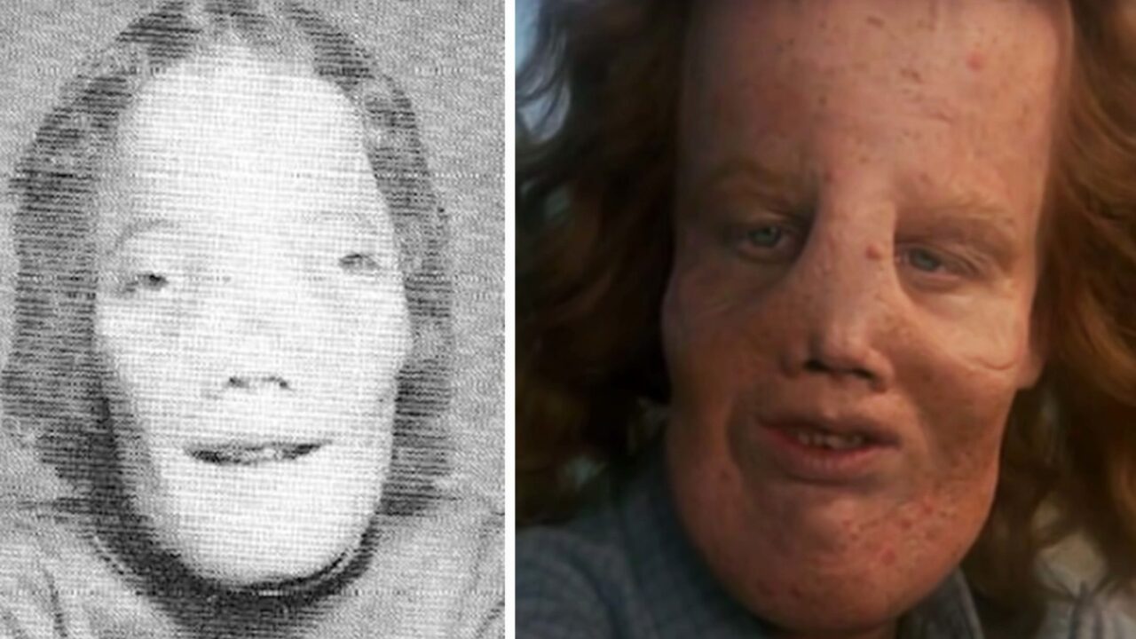 Rocky Dennis: The true story of the boy who inspired ‘Mask’