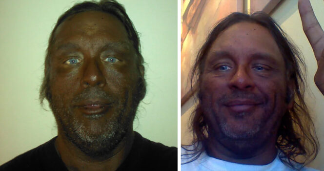 Man who used Melanotan II injections for 20 years shares his warning..